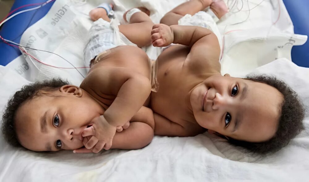 Nach einer schwierigen Operation gelang es den Ärzten, diese siamesischen Zwillinge zu trennen